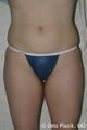 Liposuction