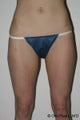 Liposuction