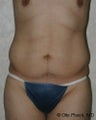 Male Liposuction