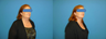 Neck Liposuction