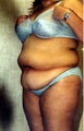 liposuction of abdomen and flanks