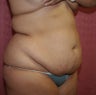 liposuction of abdomen and flanks