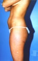 liposuction of abdomen and flanks of woman from Los Angeles