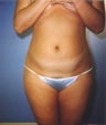 liposuction of abdomen and flanks of woman from Los Angeles