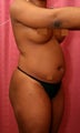 liposuction of abdomen and flanks of woman from Los Angeles