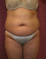 liposuction of abdomen and flanks of woman from Los Angeles