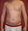liposuction of abdomen and flanks of man from Los Angeles