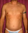 liposuction of abdomen and flanks of man from Los Angeles