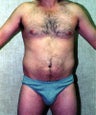 liposuction of abdomen and flanks of man from Los Angeles