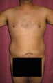 liposuction of abdomen and flanks of man from Los Angeles