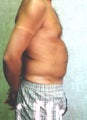 liposuction of abdomen and flanks of man from Los Angeles