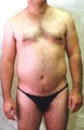 liposuction of abdomen and flanks of man from Los Angeles