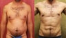 male liposuction of abdomen and flanks in los angeles