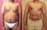 male liposuction of abdomen and flanks in los angeles