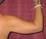 liposuction of arms for women