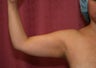 liposuction of arms for women