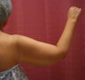 liposuction of arms for women