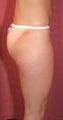 liposuction of thighs for women