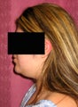 liposuction of neck & jaw line for women