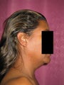 liposuction of neck & jaw line for women in Los Angeles