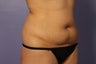 Liposuction