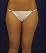 Liposuction