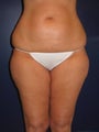 Liposuction of abdomen, hips, knees, and inner and outer thighs