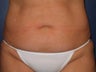 Liposuction of abdomen