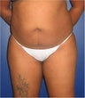 Liposuction abdomen and back