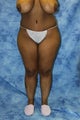 Liposuction and Fat Injection