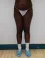Liposuction and Fat Injection