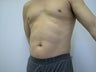 Lipo