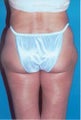 Liposuction