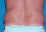 Liposuction For Men