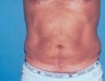 Liposuction For Men