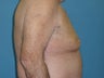 Liposuction For Men