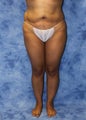 Liposuction and Fat Injection