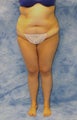 Liposuction