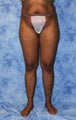 Liposuction and Fat Injection