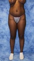 Liposuction and Fat Injection