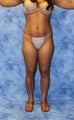 Liposuction and Fat Injection