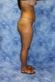 Liposuction and Fat Injection
