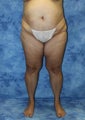 Liposuction and Fat Injection