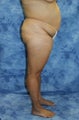 Liposuction and Fat Injection