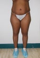 Liposuction and Fat Injection