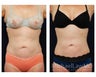 Liposuction