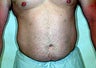 Liposuction