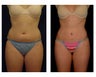 Liposuction