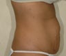 Liposuction and Tummy Tuck