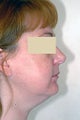 Neck Liposuction